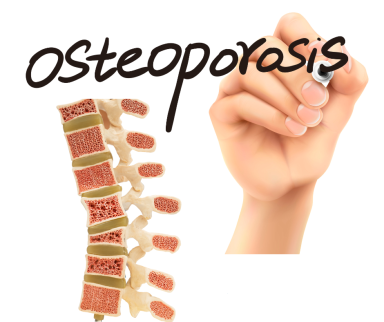 Understanding Bone Health: Osteopenia, Osteoporosis, and How to Support Stronger Bones